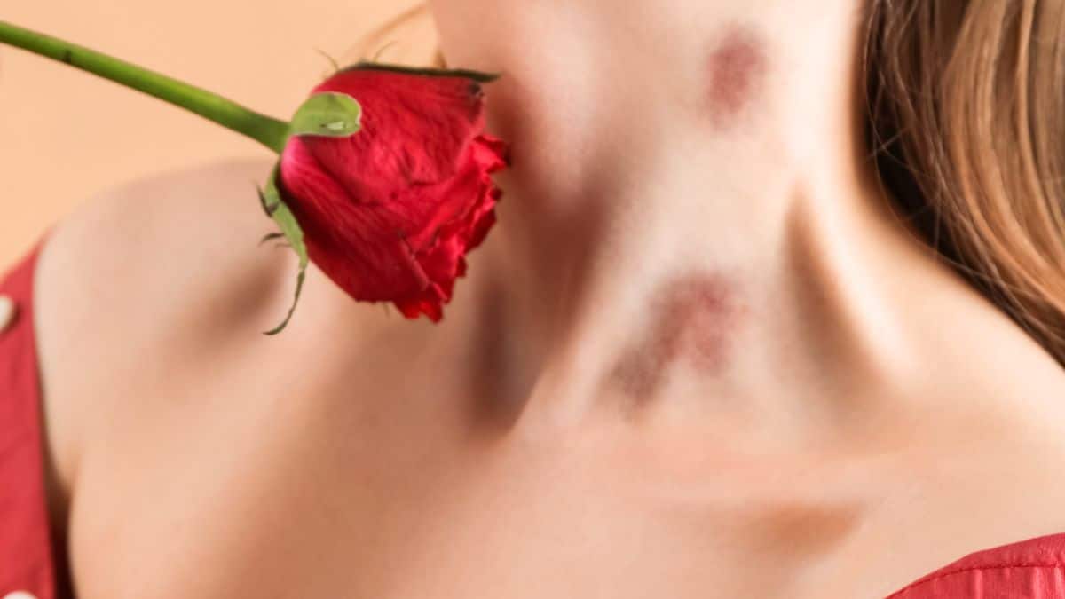 Common Excuses for hickeys